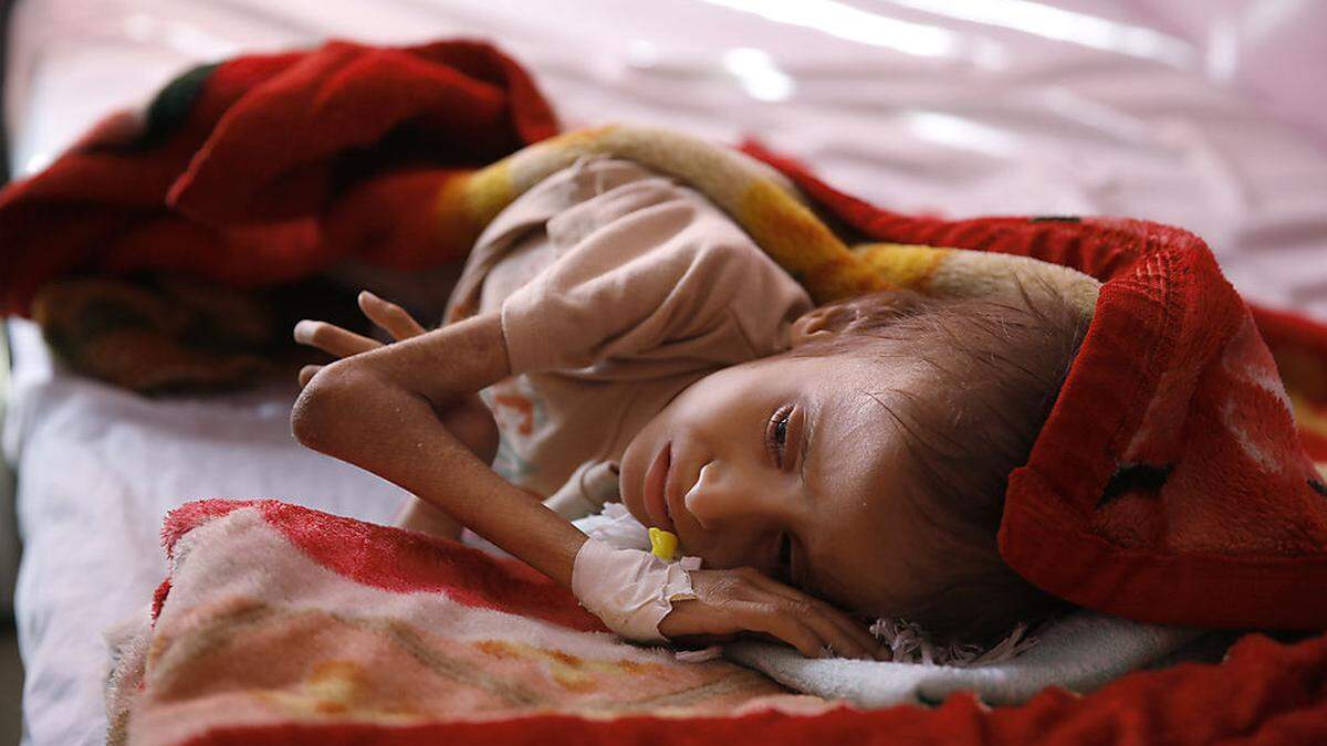 Ein unterernährtes Kind wartet auf die Behandlung in einem Krankenhaus in Sanaa