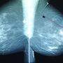 Mammografie zur Brustkrebsvorsorge