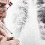 Rauchen ist der größte Risikofaktor für Lungenkrebs