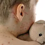 Masern ist eine hochansteckende Infektionskrankheit