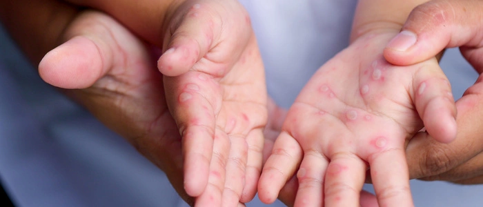 Juckend und oft auch schmerzhaft: Die Hand-Mund-Fuß-Krankheit