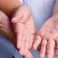 Juckend und oft auch schmerzhaft: Die Hand-Mund-Fuß-Krankheit