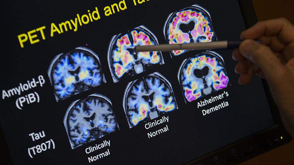 Wieder Rückschlag in Alzheimer-Forschung