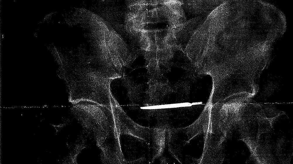 Das Röntgenbild zeigt das Skalpell 