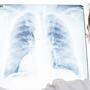 Lungenkrebs wird zum tödlichsten Krebs der Frau