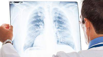 Lungenkrebs wird zum tödlichsten Krebs der Frau