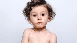 Masern sind hochansteckend