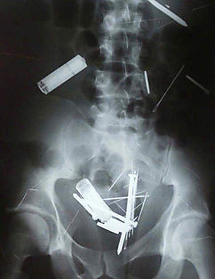 Röntgenbild: Eine Gartenschere und Messer verstecken sich hier