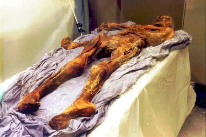 Parodontitis, Borreliose, Laktoseintoleranz, Gallensteine, Arterienverkalkung und Würmer - 25 Jahre Forschung an der Gletscherleiche "Ötzi" haben seine mannigfaltigen Krankheiten zutage gefördert. Wissenschafter untersuchten nicht nur seine Tätowierungen, seinen Mageninhalt und seine Darmbakterien, sondern fanden auch Verwandte, rekonstruierten ihn und gaben ihm zuletzt sogar eine Stimme.
