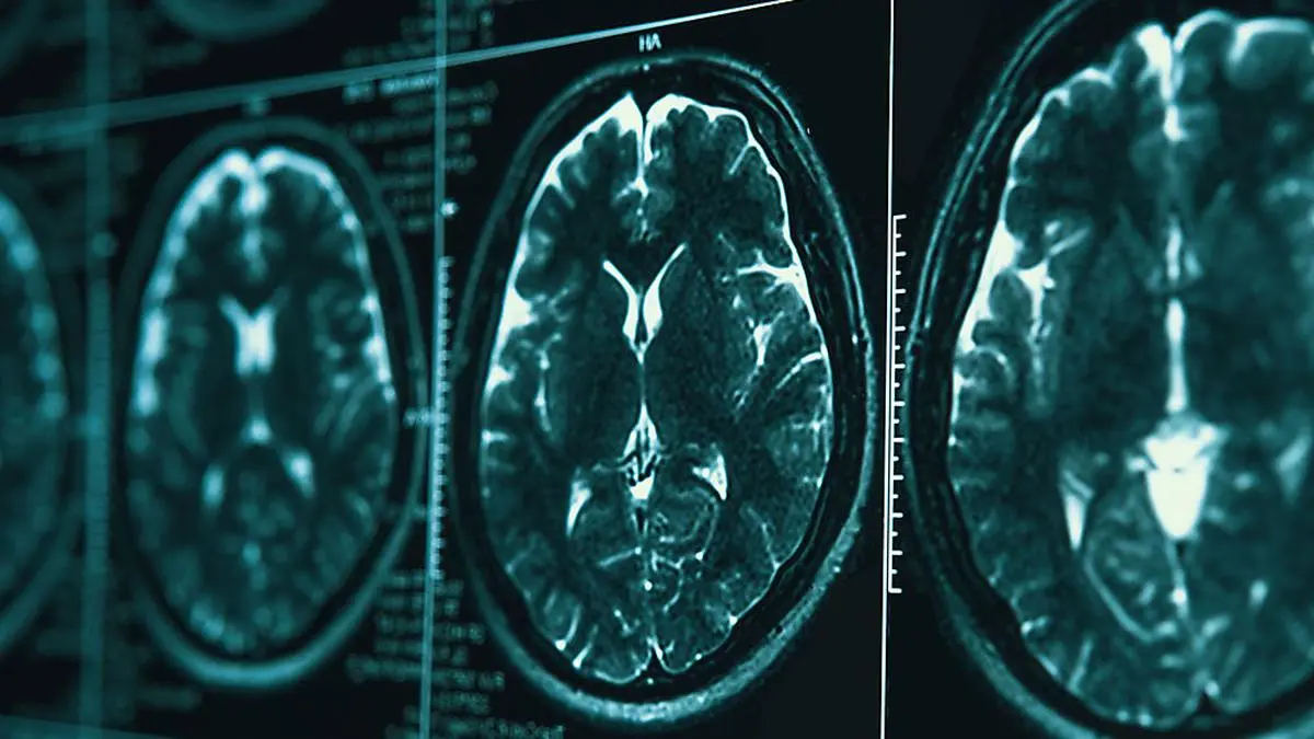 MRI or magnetic resonance image of head and brain scan. Close up view, toned image