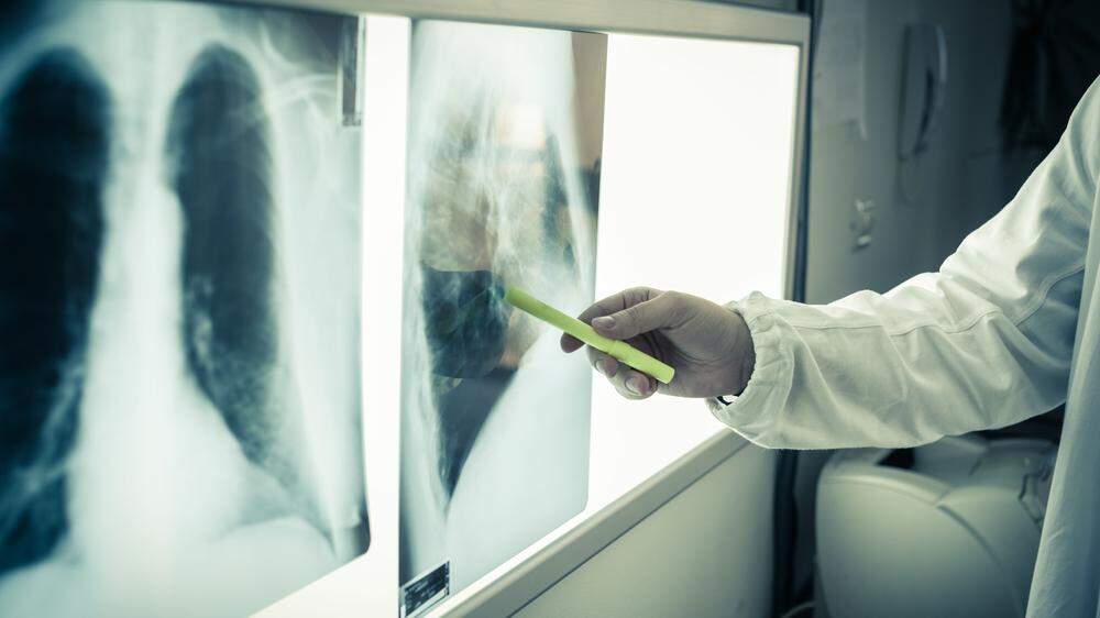 In Österreich erkranken jedes Jahr knapp 5000 Menschen an Lungenkrebs