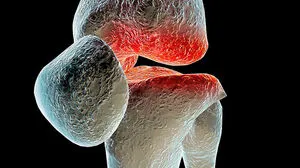 Arthrose in den Gelenken 