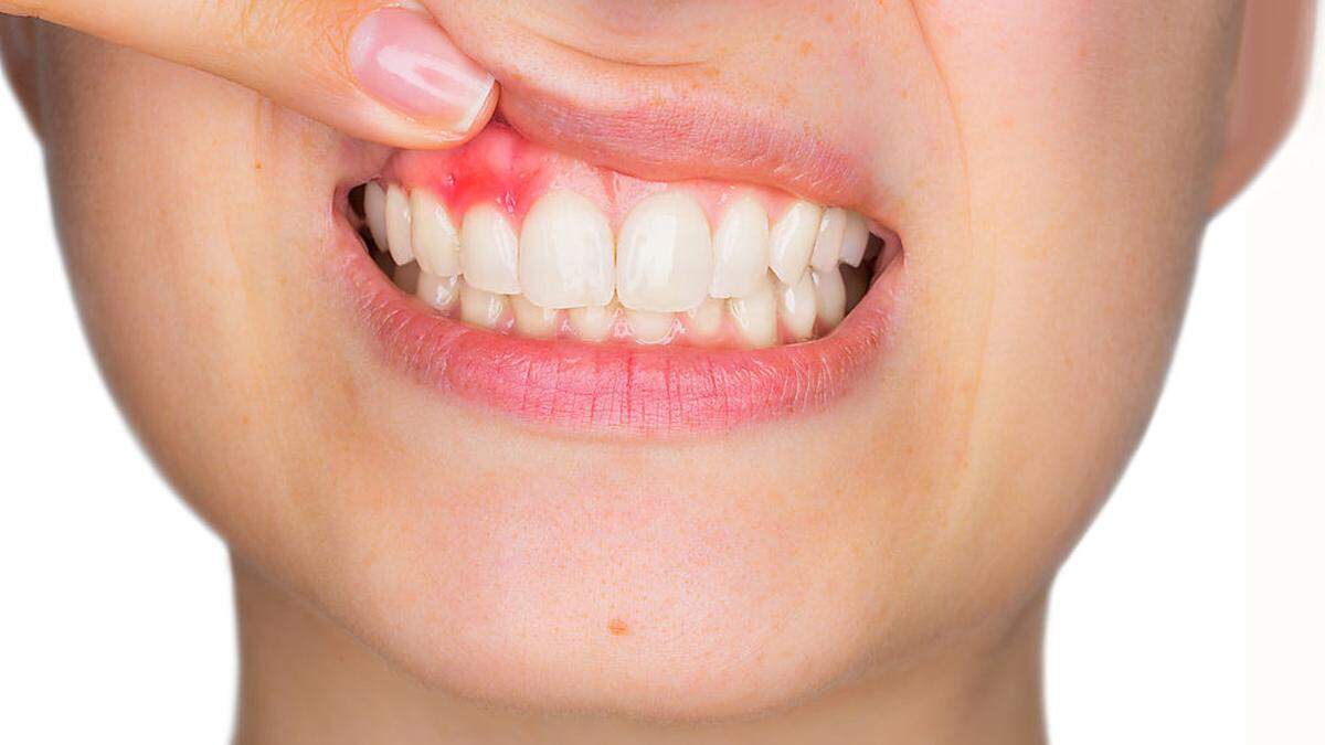 Zahnfleischbluten ist ein Symptom