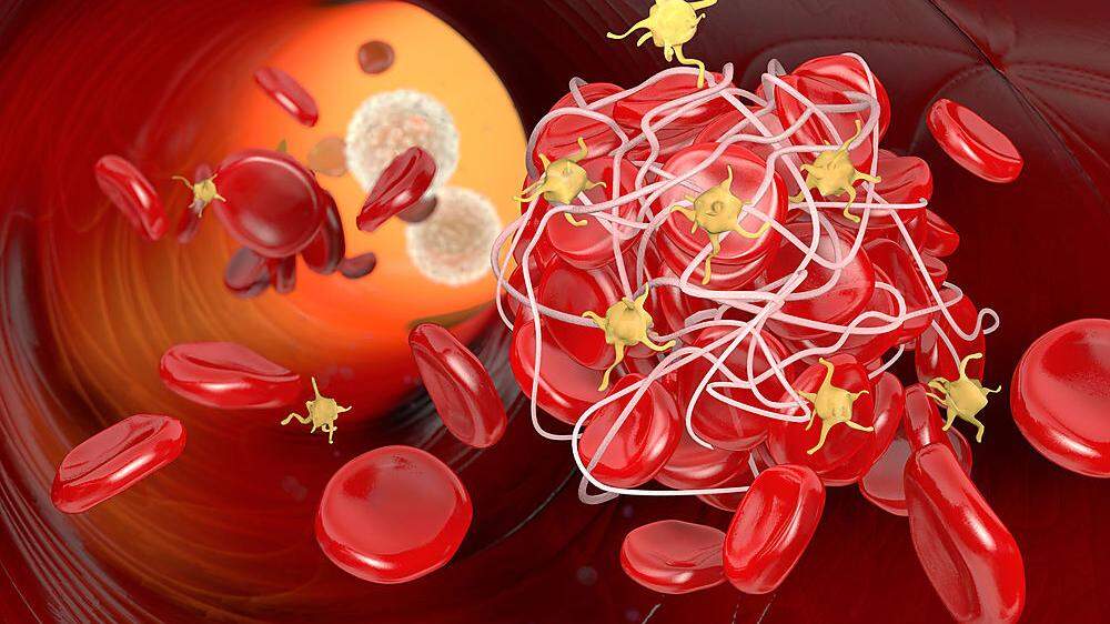 Blutgerinnsel, die durch eine Covid-19-Infektion entstehen, bleiben besonders lange stabil
