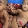 Tofa und Tahura vor ihrer Operation