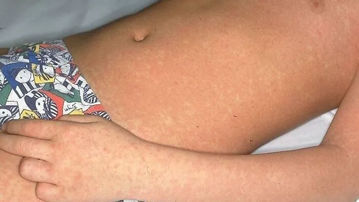 Die leise Hoffnung von offizieller Seite auf ein zumindest vorläufiges Ende der Epidemie wurde damit enttäuscht