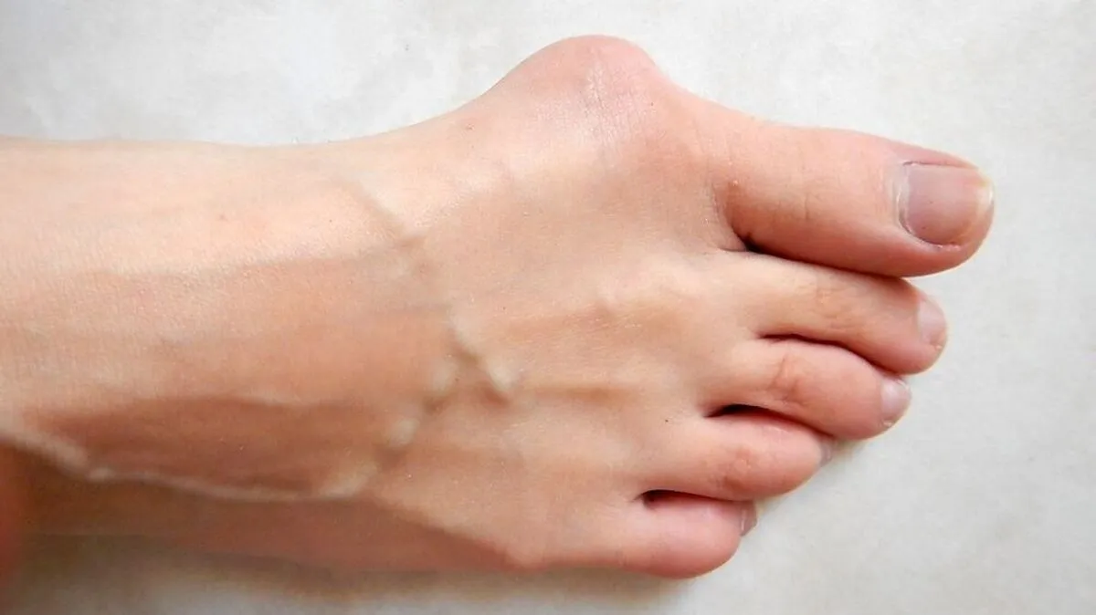 Hallux valgus