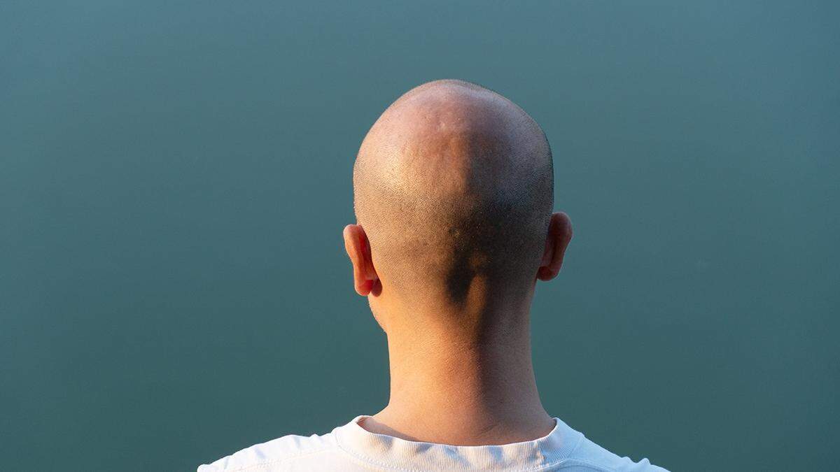 Haarausfall geht vor allem bei jüngeren Männern oft mit einer großen psychischen Belastung einher (Symbolbild)