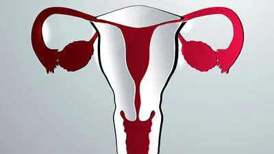 Krebs der Eierstöcke wird meist zu spät erkannt