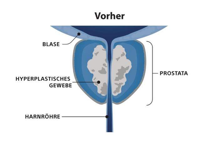 Die gutartige Prostatavergrößerung ist ein sehr häufiges Krankheitsbild bei Männern über 50 Jahren: Die vergrößerte Prostata drückt auf die Harnröhre drückt und blockiert so den Harnfluss.