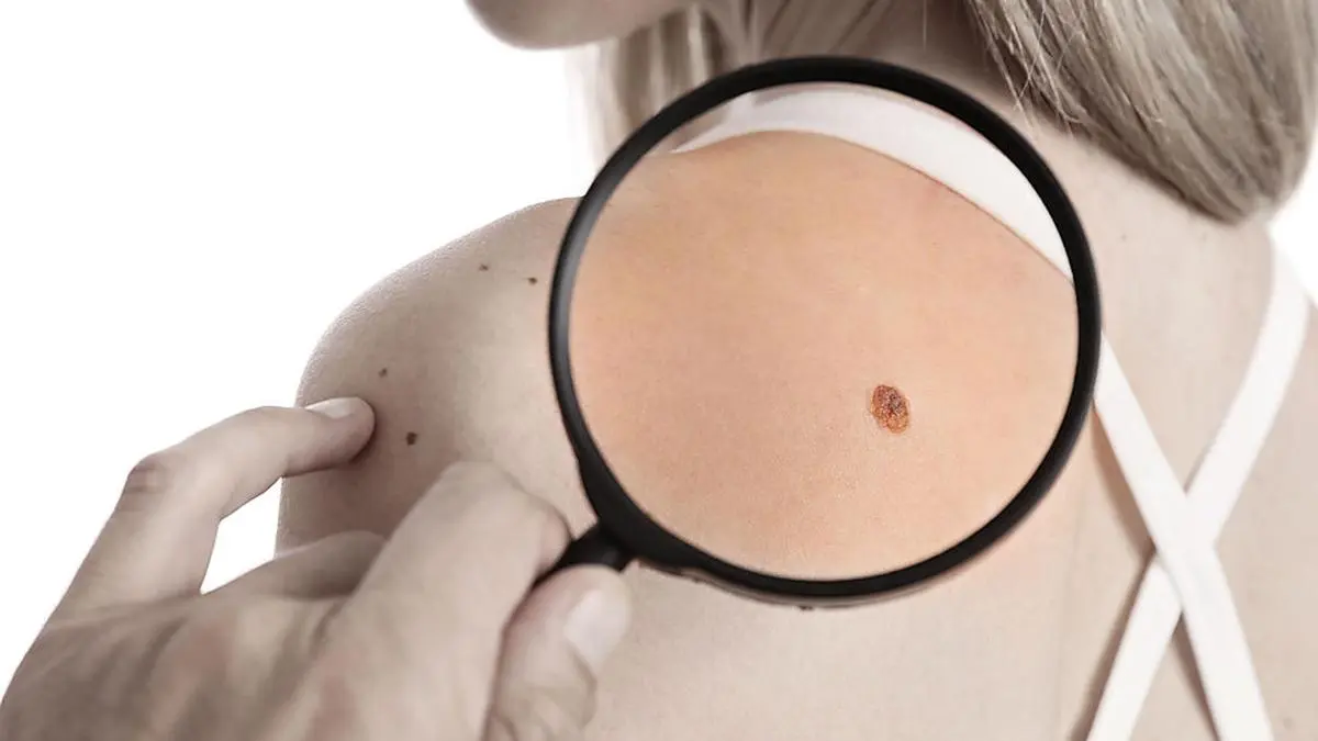 Doctor dermatologist examines birthmark of patient. Checking benign moles. Laser Skin tags removal