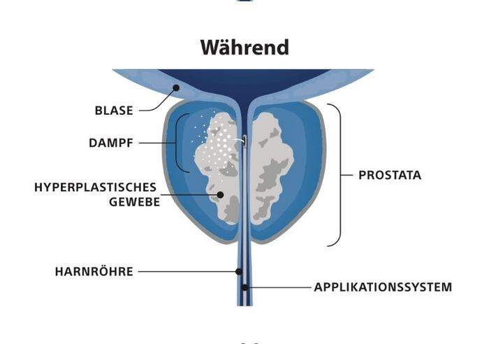 Bei der Wasserdampftherapie werden sehr kleine Mengen Dampf an die vergrößerte Prostata abgegeben