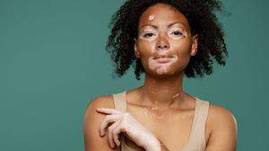 Vitiligo: Was hinter den weißen Flecken steckt