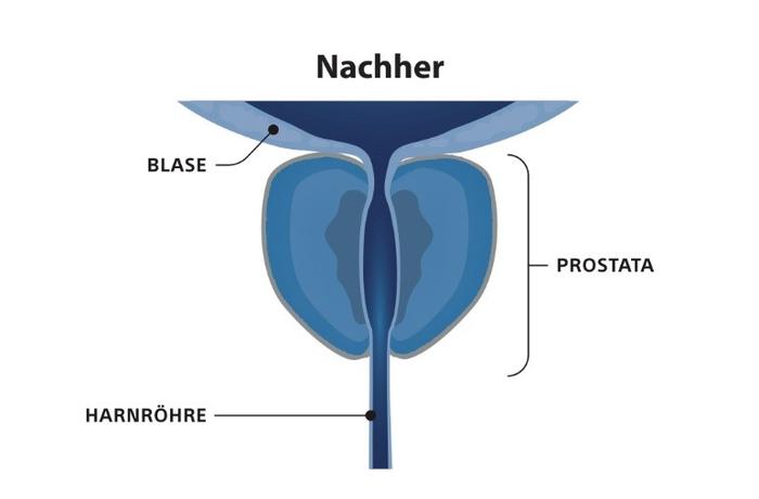 Die freigegebene Energie führt zum Absterben der Prostatazellen. Im Laufe der Zeit werden die abgestorbenen Zellen durch den natürlichen Heilungsprozess Ihres Körpers abgebaut, wodurch die Prostata schrumpft.