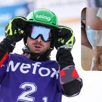 Alex Payer, so sieht derzeit sein Knie aus (rechts)