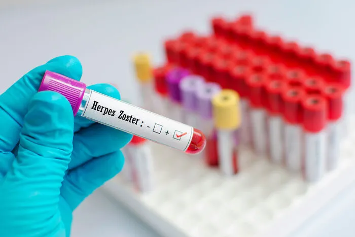Erwachsene ab 50 Jahren und solche mit stark geschwächtem Immunsystem sollten sich laut österreichischem Impfplan gegen Gürtelrose impfen lassen