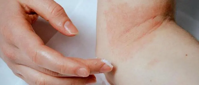 Neurodermitis: Telemedizin wirkt so gut wie ein Hautarztbesuch