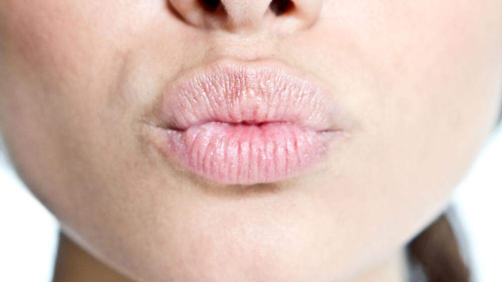 Lippen unbedingt vor zu starker Sonnenstrahlung schützen!