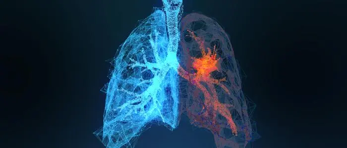Lungenkrebs ist weltweit die tödlichste Krebserkrankung: Warum Experten das Vorsorge-Screening fordern