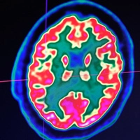 Laut Schweizer Medizinern Meilenstein für Therapie
