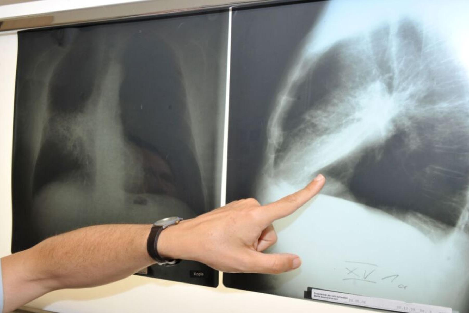 Washington/Wien: Digitale Information für Lungenkrebs-Früherkennung