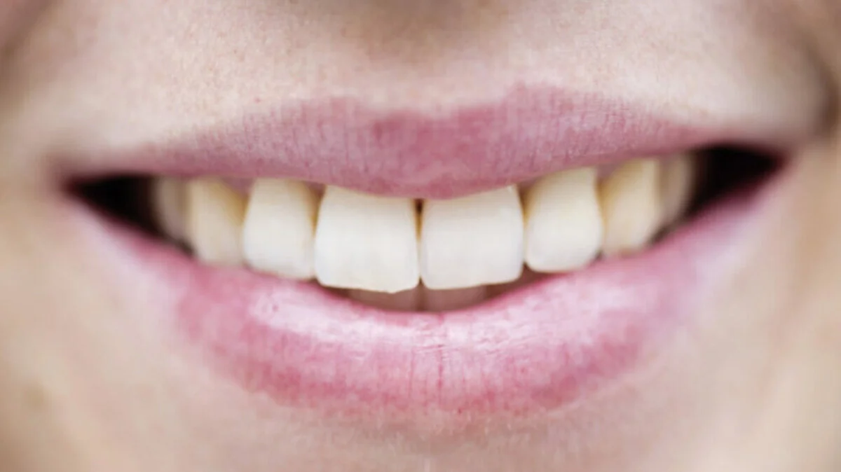 Elf Do-it-yourself-Produkte fürs Zahnbleaching getestet | Elf Do-it-yourself-Produkte fürs Zahnbleaching getestet