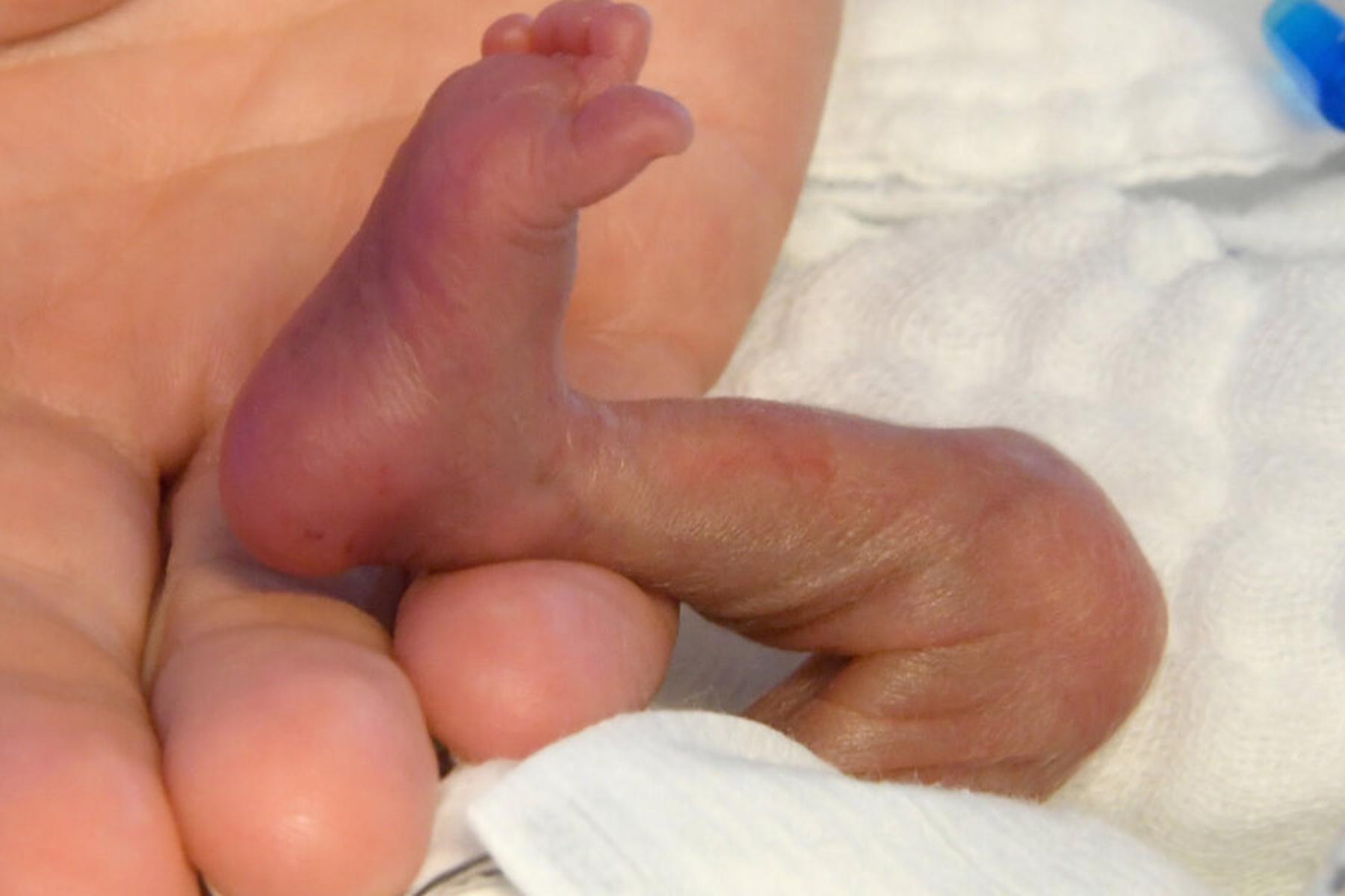 Bozen: Frühchen starben im Krankenhaus Bozen an Bakterien-Infektion