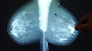 Das Röntgenbild gehörte zu einer anderen Patientin mit (fast) identem Namen (Symbolbild)