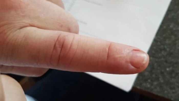 Die Narbe an Lafers linkem Zeigefinger