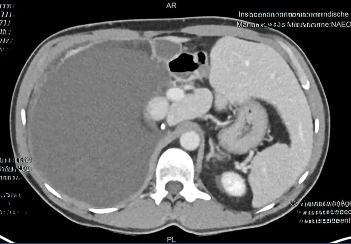 Beim dunkelgrauen Bereich links im Bild handelt es sich um den Tumor. Er lag  zwischen Leber, rechter Niere, großer Körperschlagader und Dickdarm