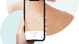 SkinScreener: Hautveränderungen per App screenen und eine Risikoeinschätzung erhalten 